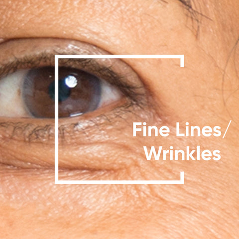 Fine Lines / Wrinkles