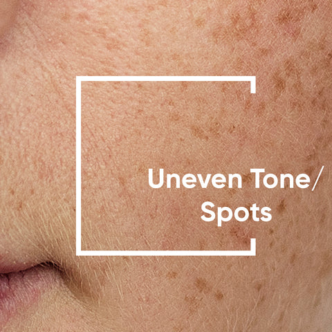 Uneven Tone & Dark Spots